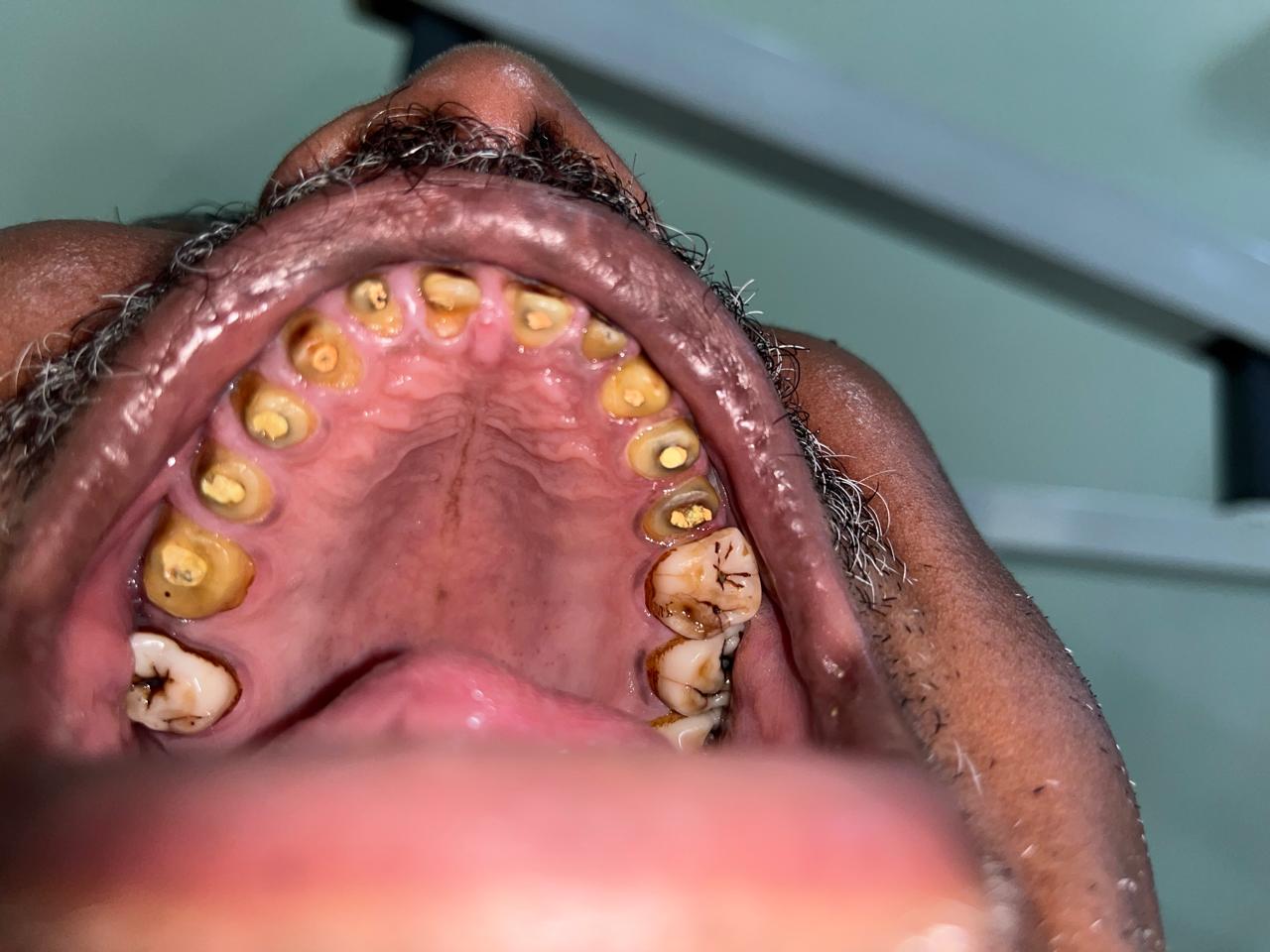 Dental Implant Procedure Overview