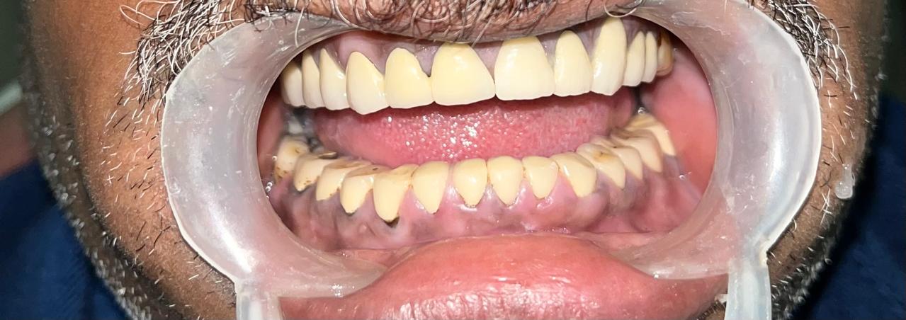 Premium Dental Implant Structure