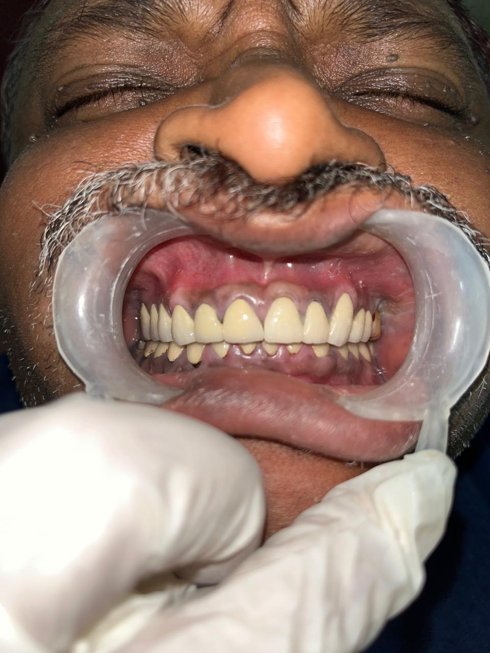 Before & After Dental Implant